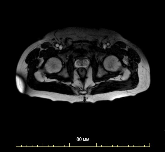 Как делают МРТ тазобедренного сустава