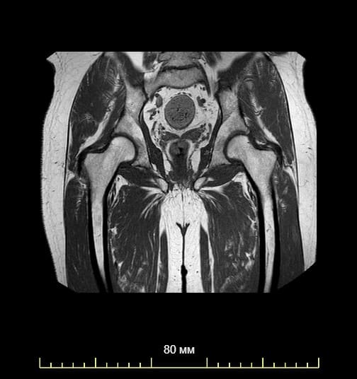 Мрт тазобедренного сустава