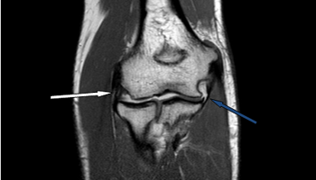 Lateral ulnar collateral ligament