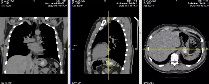 выявление патологии на кт средостения