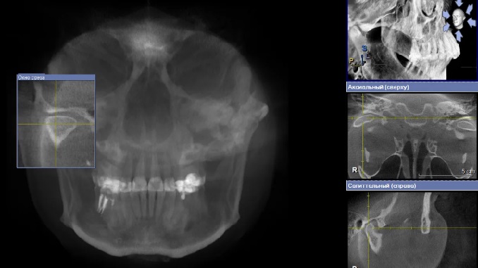 томография нижнецелюстного сустава
