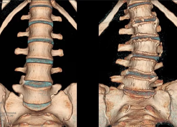 МСКТ пояснично-крестцового отдела позвоночника