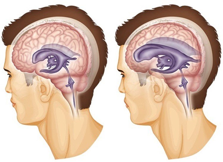 МРТ при гидроцефалии головного мозга у взрослых, эффективность МРТ при гидроцефалии