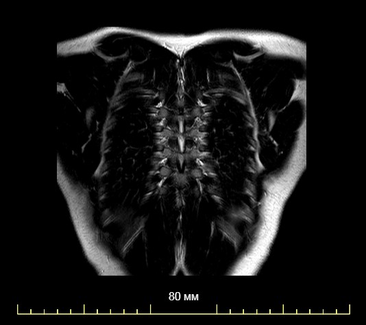 Что показывает МРТ позвоночника