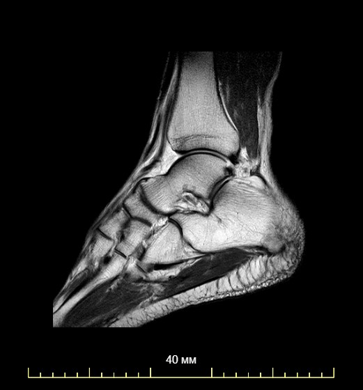 Мрт голеностопного сустава что показывает фото