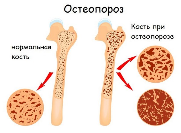 Остеопороз: лечение, симптомы и диагностика