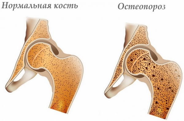 Клиническая картина остеопороза