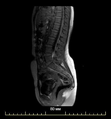 Мрт поясничного отдела позвоночника фото