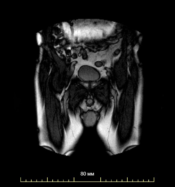 МРТ простаты, когда нужно сделать магнитно-резонансную томографию представительной железы?