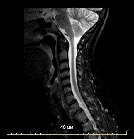 Мрт шейного отдела фото