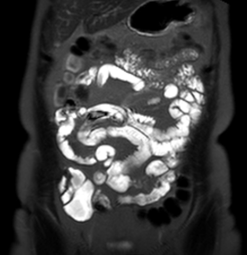 Мрт кишки. Кт энтерография тонкого кишечника. Мрт энтерография кишечника. Моники кт энтерография.