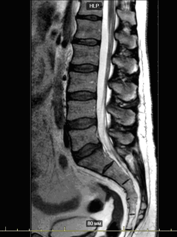 Мрт пояснично крестцового отдела фото
